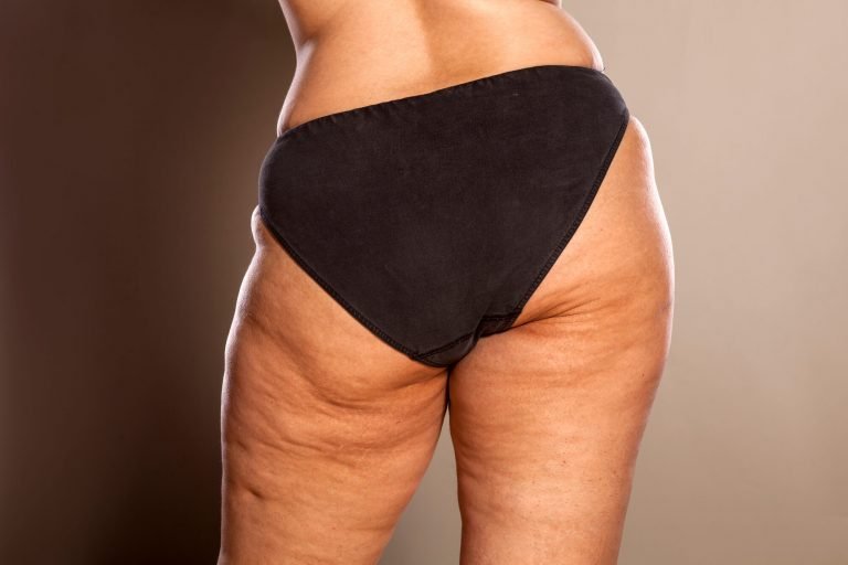 QUELLES SONT LES CAUSES DE L'APPARITION DE LA CELLULITE ?