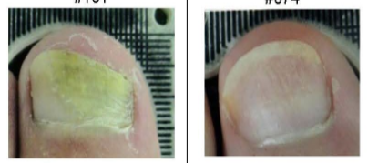 lunula laser multilaser onycomicosis lunula laser multilaser onycomicosis
