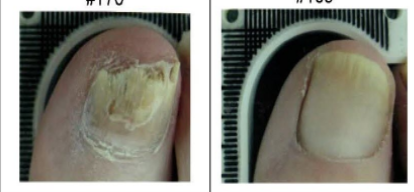 lunula laser multilaser onycomicosis lunula laser multilaser onycomicosis
