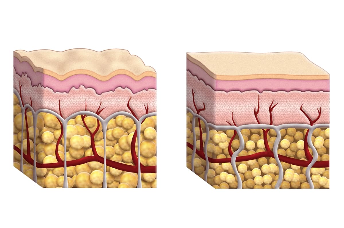 Est-il nécessaire de perdre du poids pour éliminer la cellulite ? Est-il nécessaire de perdre du poids pour éliminer la cellulite ?