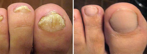 onicomicosis-det