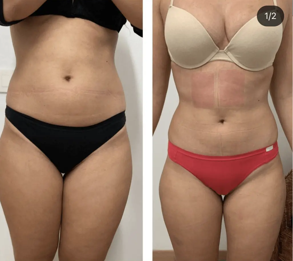 Testimonial protocoles d'amincissement