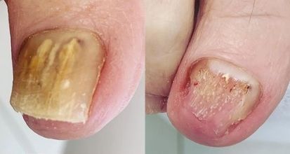 Lunula Onychomicose avant apres Lunula Onychomicose avant apres