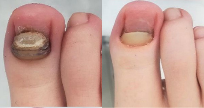 Lunula Onychomicose avant apres Lunula Onychomicose avant apres