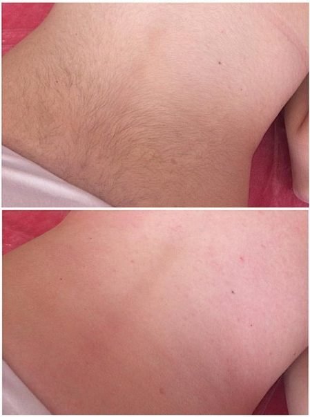 epilation definitive epilation definitive