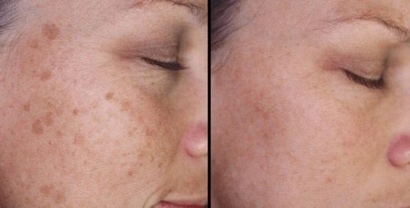 Taches sur le visage quels sont les types de taches
