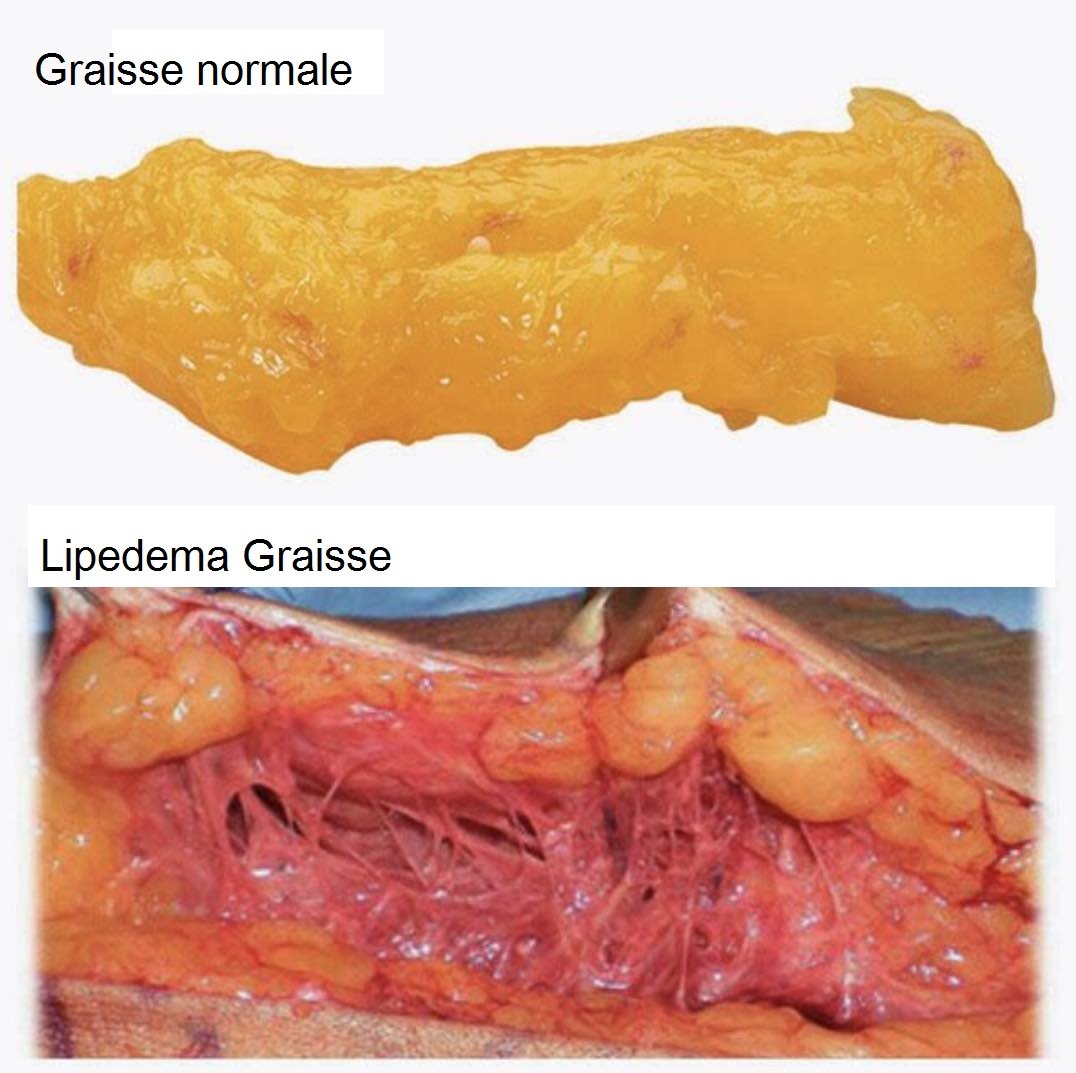 lipedemafat