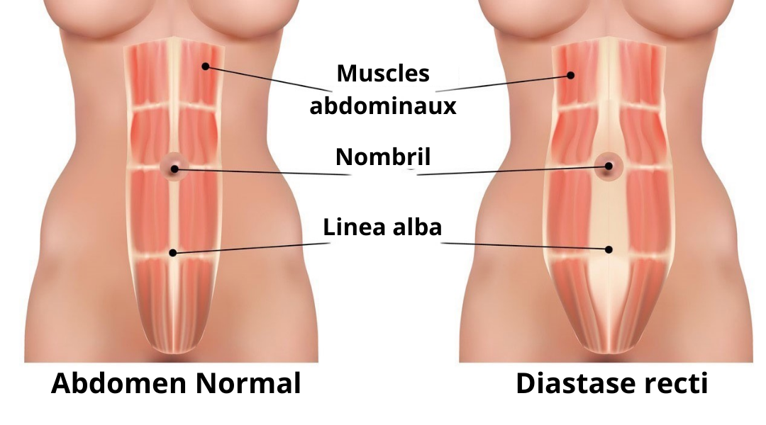 Le diastasis c est quoi?