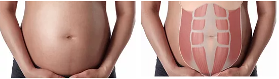 diastasis