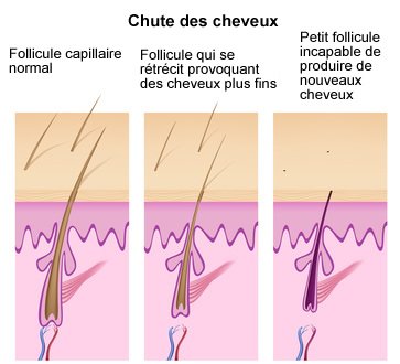 chute-cheveux-symptomes-infographie-creapharma