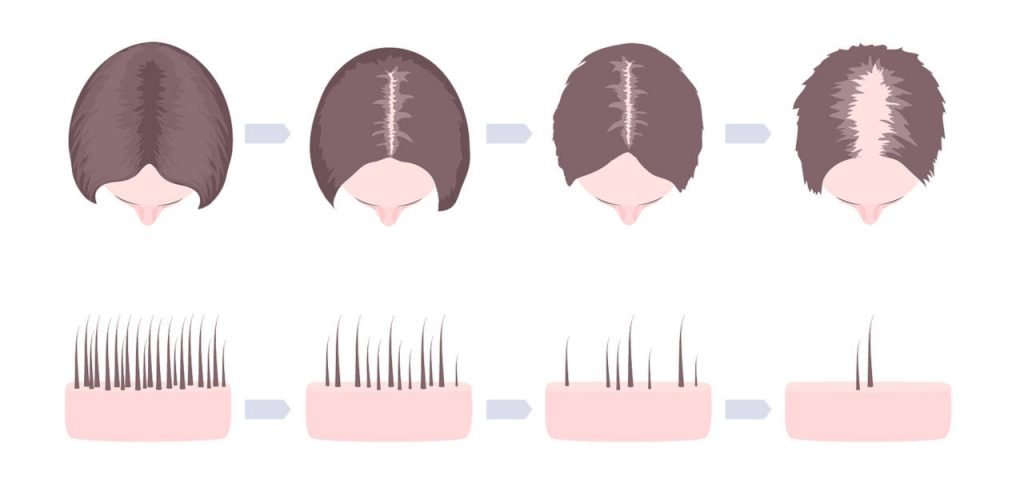 types d'alopécie androgénique ou féminine