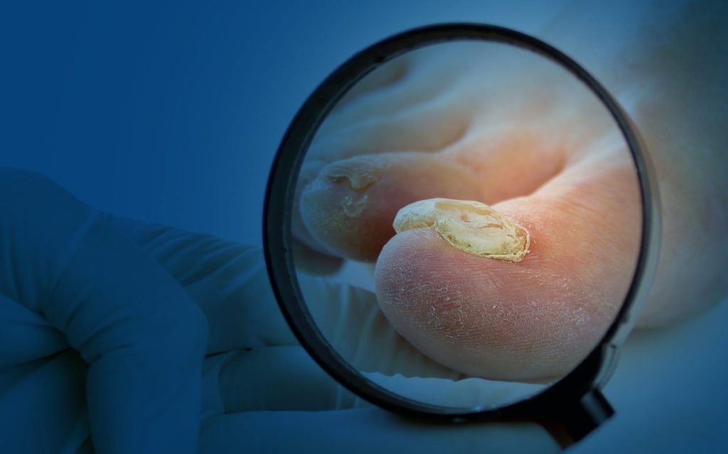 ONYCHOMICAL TREATMENT AND PSORIASIS